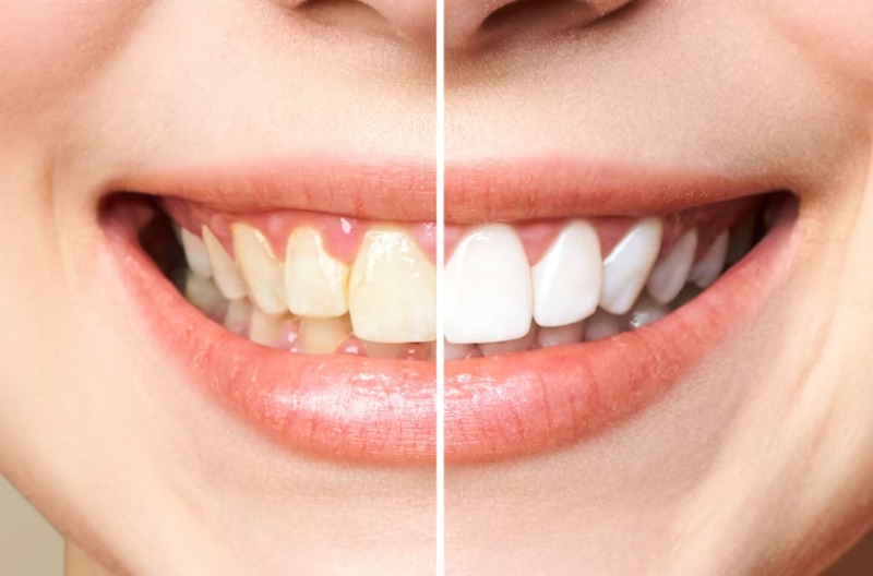 Get the Best Teeth Whitening Services Winnipeg