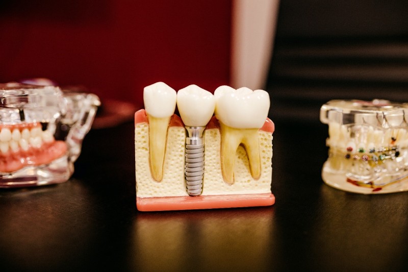 Lakeview Dental: Get the Best Dental Implants in Kelowna
